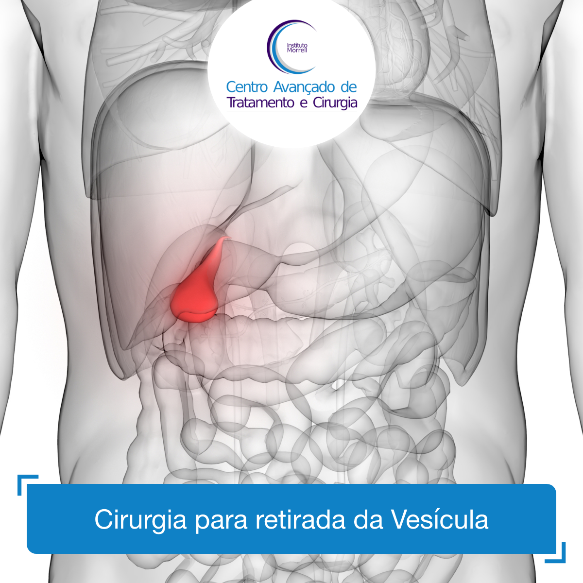 INSTITUTO_MORRELL-2018-Cirurgia_para_retirada_da_Vesícula-1200x1200.png