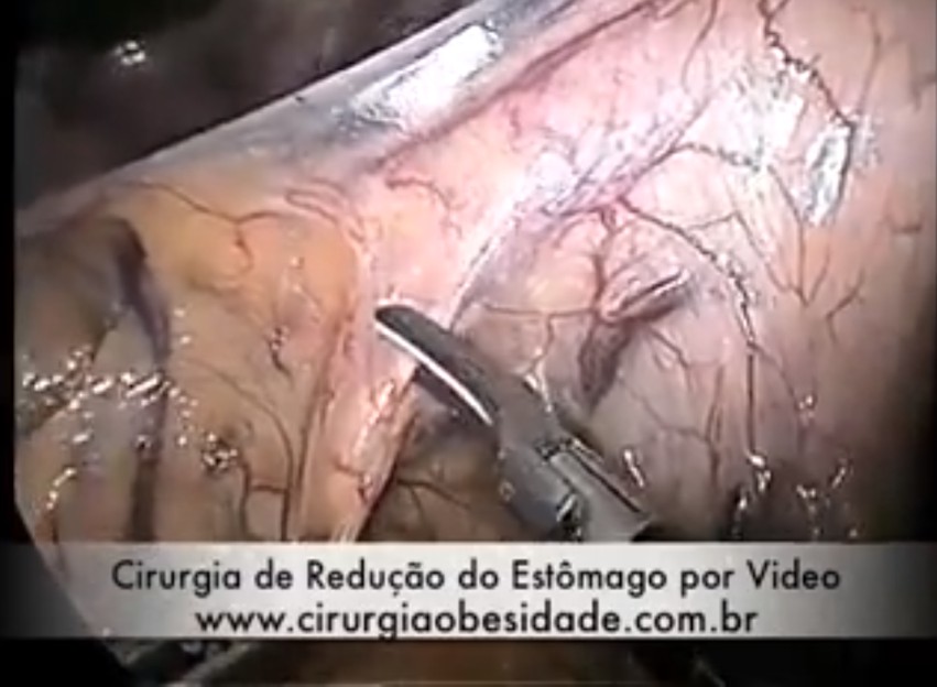cirurgia-da-obesidade-video.jpg