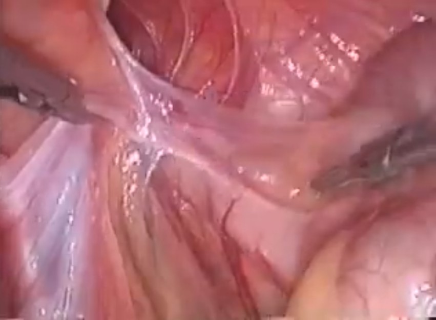 cirurgia-hernia-video.jpg